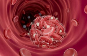 جسيمات خطيرة" تتسلل إلى الشرايين وتهددنا بجلطات قاتلة