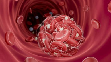 جسيمات خطيرة" تتسلل إلى الشرايين وتهددنا بجلطات قاتلة