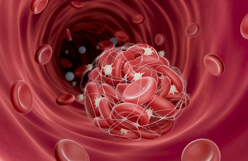 جسيمات خطيرة" تتسلل إلى الشرايين وتهددنا بجلطات قاتلة