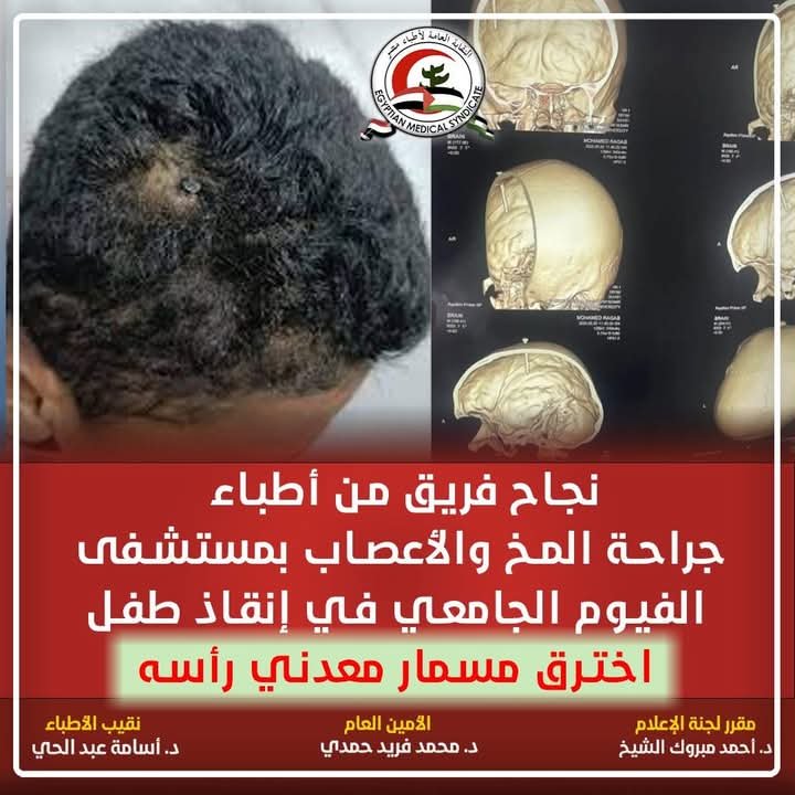 مصر.. نجاح فريق أطباء جراحة المخ والأعصاب من إنقاذ طفل اخترق مسمار معدني رأس